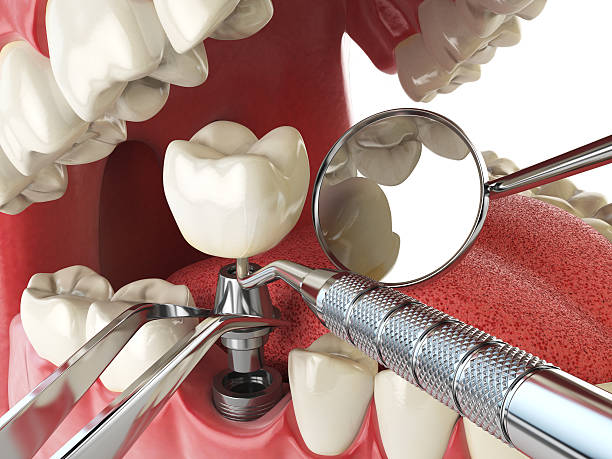 Best Emergency Broken Tooth Repair in Lake Alfred, FL